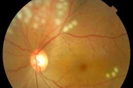 匐行性脈絡膜萎縮，最常見的表現為視力下降，目前病因尚不明確