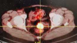 卵巢癌術後盆腔復發引起腸梗阻，棘手的問題