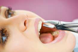 拔牙導致顱內感染？當心“小”手術出大問題！