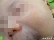 3個月寶寶嘴唇長青斑塊，初步判斷是海綿狀血管瘤，家長應怎麼判斷